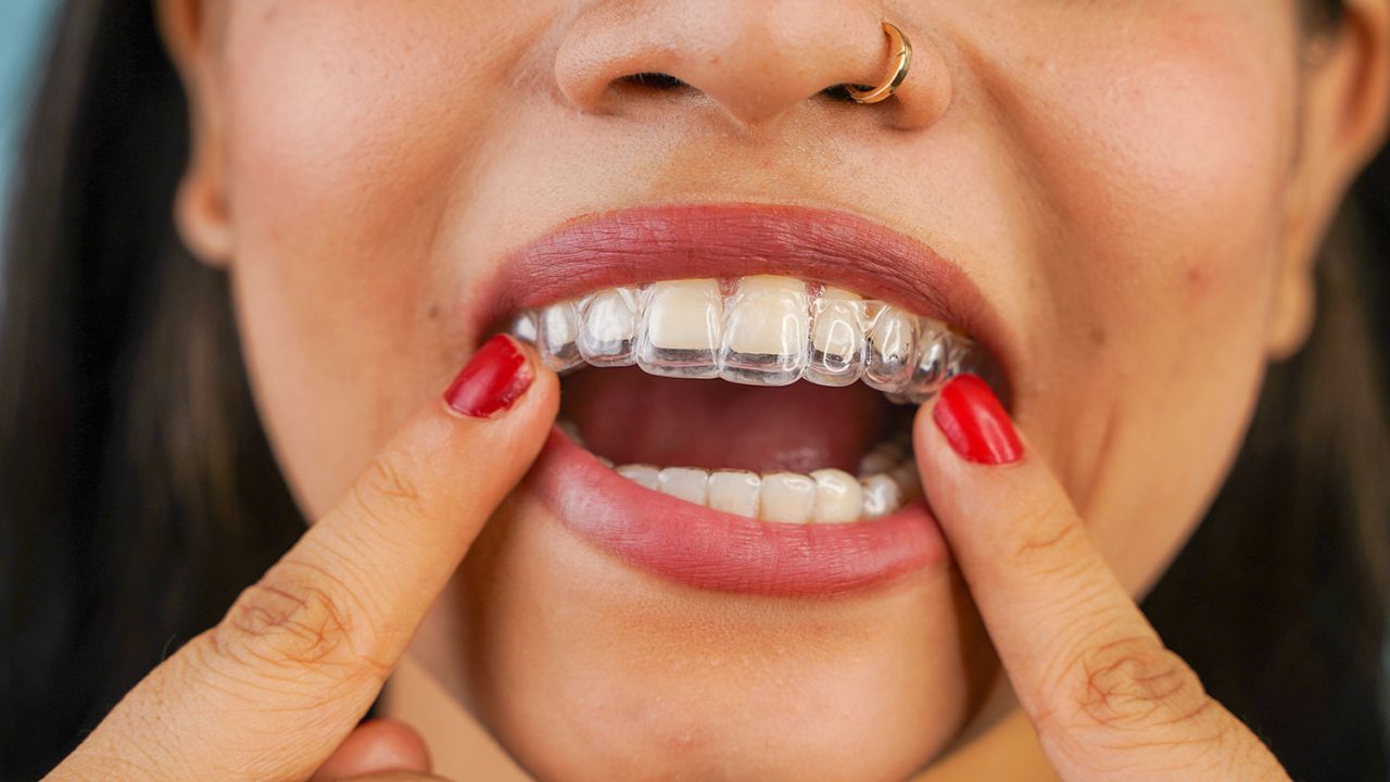 How Invisalign Supports Gum Health During Orthodontic Treatment