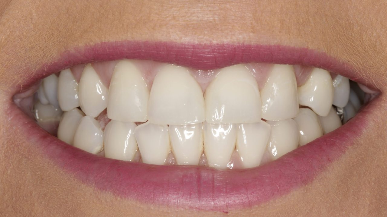 Why Composite Bonding Has Become the First Choice for Subtle Smile Corrections