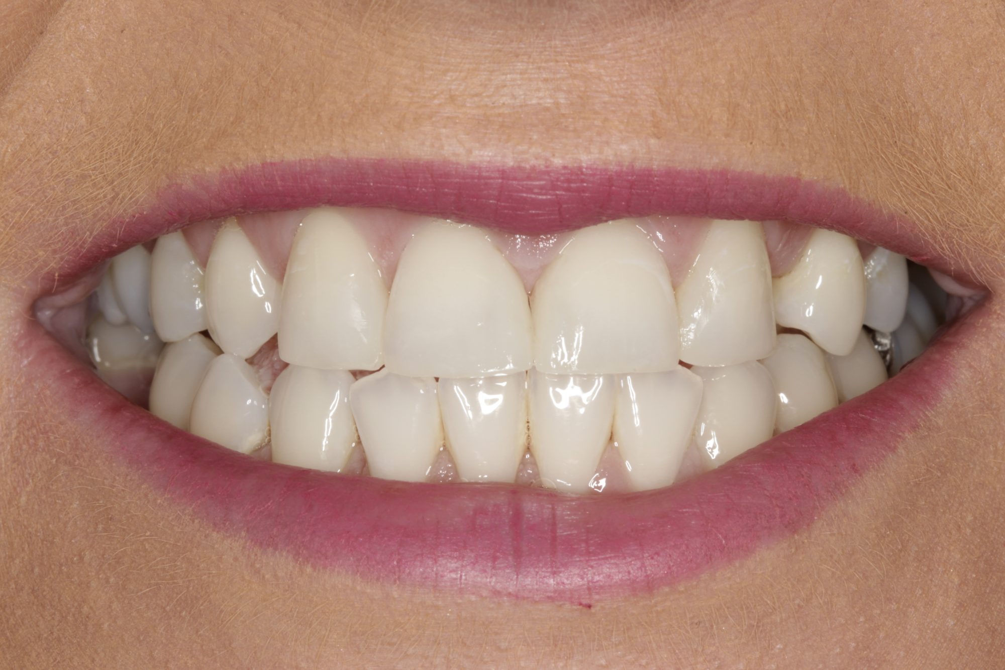 Why Composite Bonding Has Become the First Choice for Subtle Smile Corrections